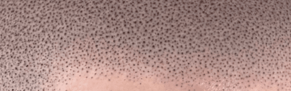 DXBLACK 머신 - 도트시술 결과 이미지