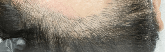 일반, PMU 머신 - 선 시술 결과 이미지